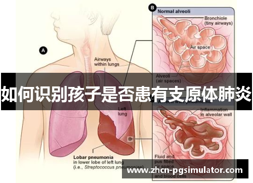 如何识别孩子是否患有支原体肺炎